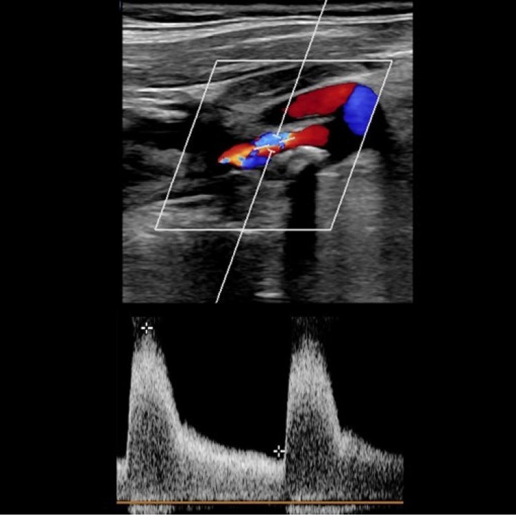 Refresher Neurosonologiekurs